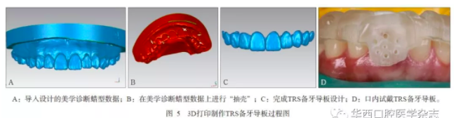 深度：3D打印在口腔美學修復中的應(yīng)用