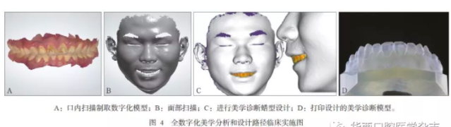 深度：3D打印在口腔美學修復中的應用