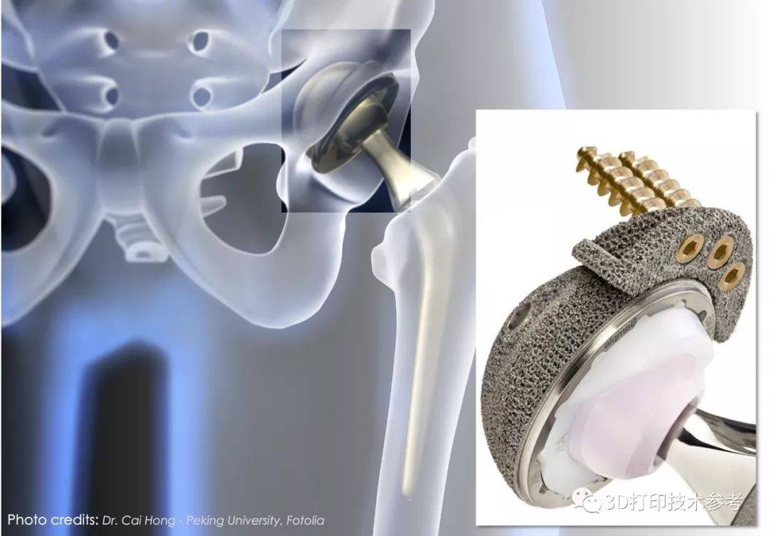 醫(yī)療：PEEK相較金屬植入物的優(yōu)勢與不足