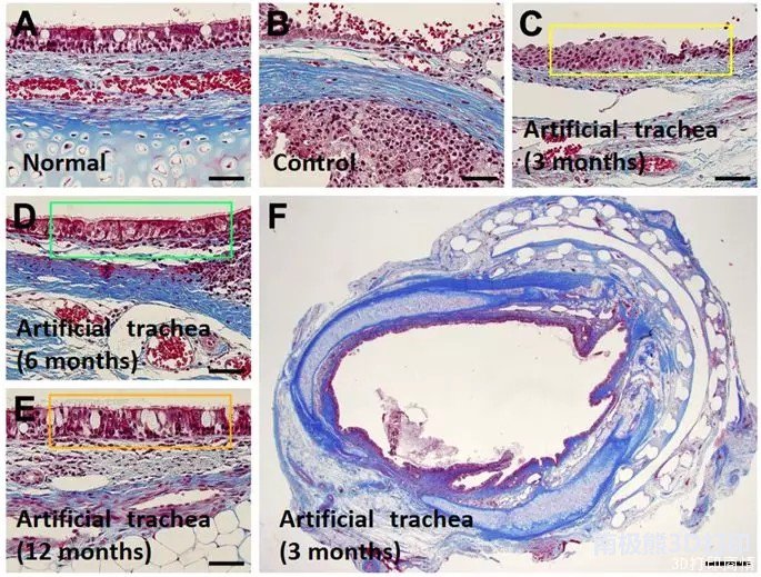 韓國(guó)研究人員用上皮細(xì)胞和軟骨細(xì)胞3D打印氣管