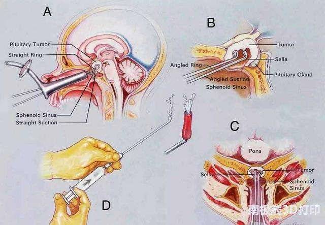 3D打印技術(shù)在醫(yī)學(xué)界的又一潛在應(yīng)用：改善垂體腺瘤手術(shù)效果