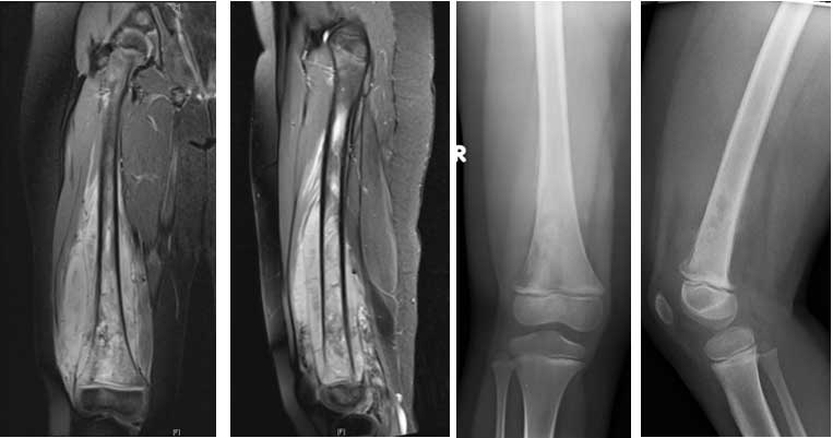3D打印技術(shù)幫助五歲的女孩再次跳舞