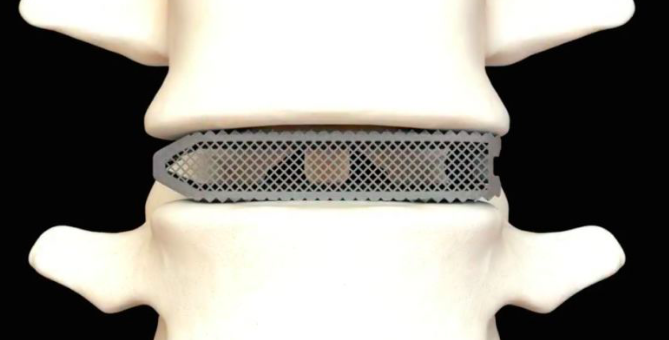 外科醫(yī)生植入世界上第一個3D打印的Aries L椎體間融合器