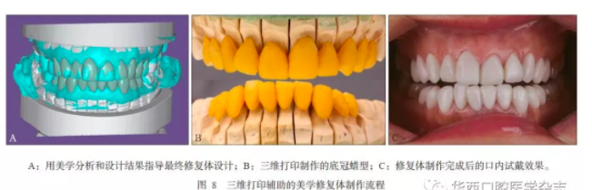 深度：3D打印在口腔美學修復中的應用