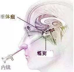 3D打印技術在醫學界的又一潛在應用：改善垂體腺瘤手術效果