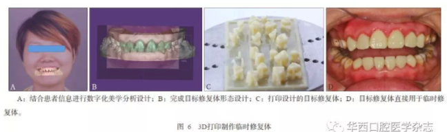 深度：3D打印在口腔美學修復中的應(yīng)用